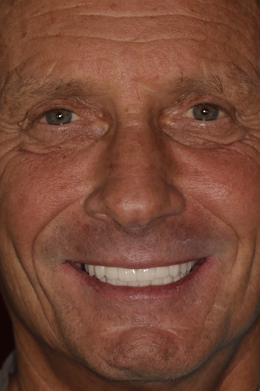 All-on-6 Bridge on Implants